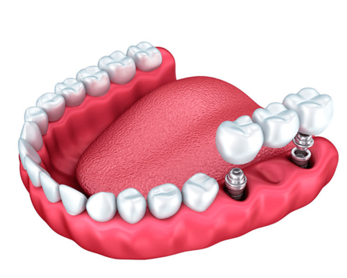 IMAGENS IMPLANTES (1) (1)