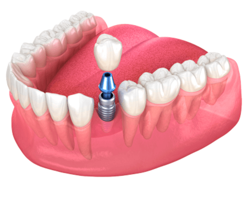 IMAGENS IMPLANTES (4)